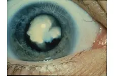 Katarakt Çeşitleri Nelerdir? Katarakt Çeşitleri Nelerdir?