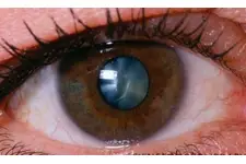 Katarakt Hastalığı Belirtileri ve Tedavisi Katarakt Hastalığı Belirtileri ve Tedavisi