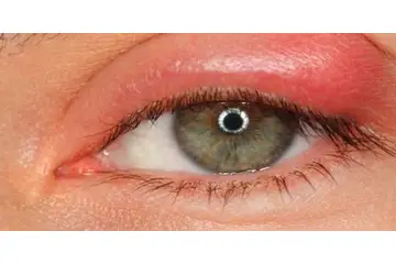 Katarakt Ameliyatı Sonrası Gözde Kanlanma