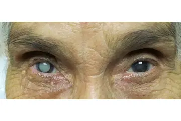 Katarakt Nedir? Belirtileri ve Tedavisi