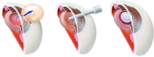 Fako Katarakt Ameliyatı Riskleri ve Sonrası