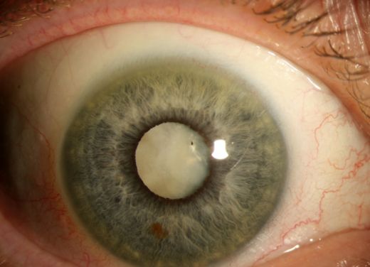 Katarakt Belirtileri ve Tedavisi