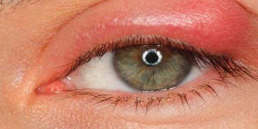 Katarakt Ameliyatı Sonrası Gözde Kanlanma