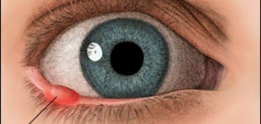 Katarakt Bitkisel Tedavi Yöntemleri Nelerdir?