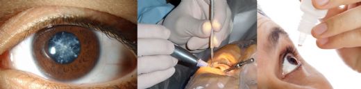 Katarakt Damlası Özellikleri ve Faydaları Nelerdir?