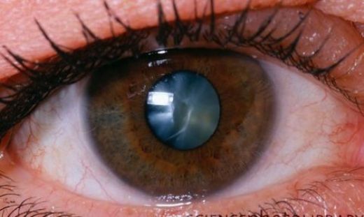 Katarakt Hastalığı Belirtileri ve Tedavisi