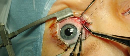 Katarakt İlacı Kullanımı ve Faydaları Nelerdir?