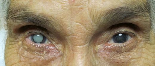 Katarakt Nedir? Belirtileri ve Tedavisi